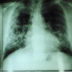 Importancia de la hisotir laboral para la silicosis
